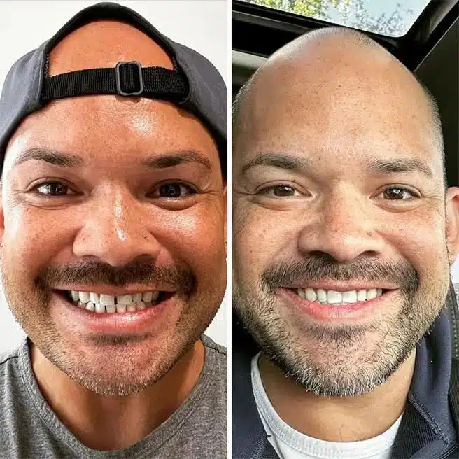 Before and after look at a man's teeth with Invisalign