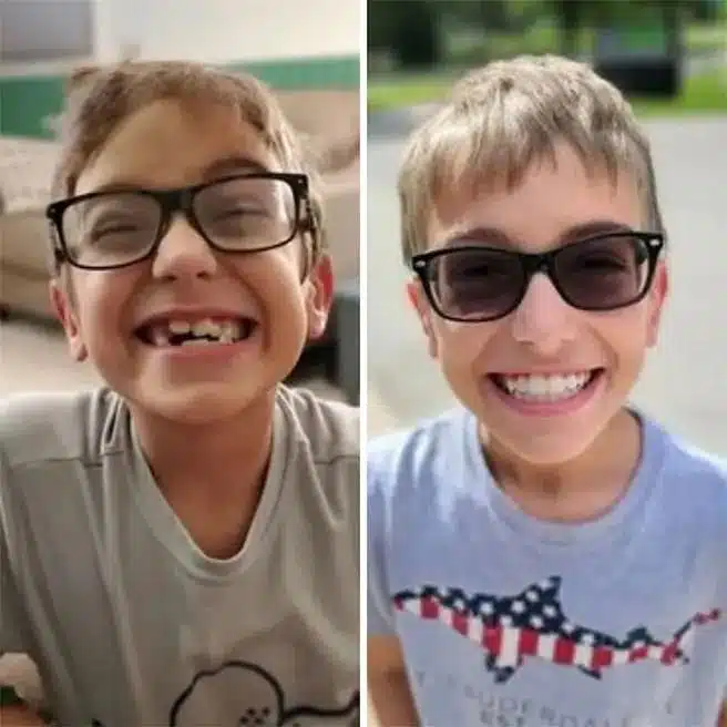 Before and after look at a child's teeth with Invisalign