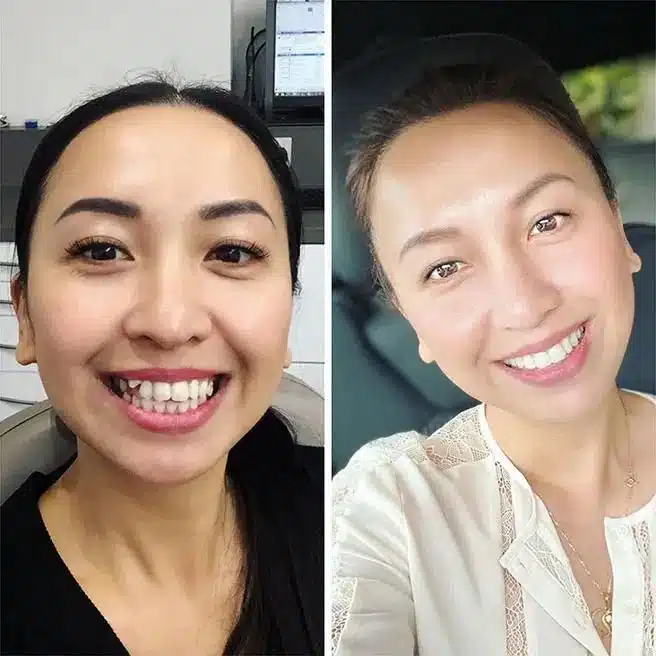 Before and after look at a patient's teeth with Invisalign