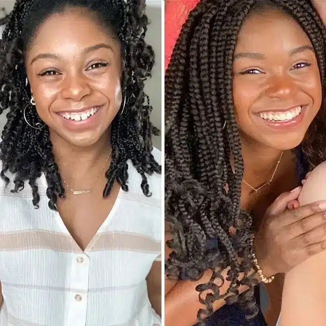 Before and after look at a woman's teeth with Invisalign