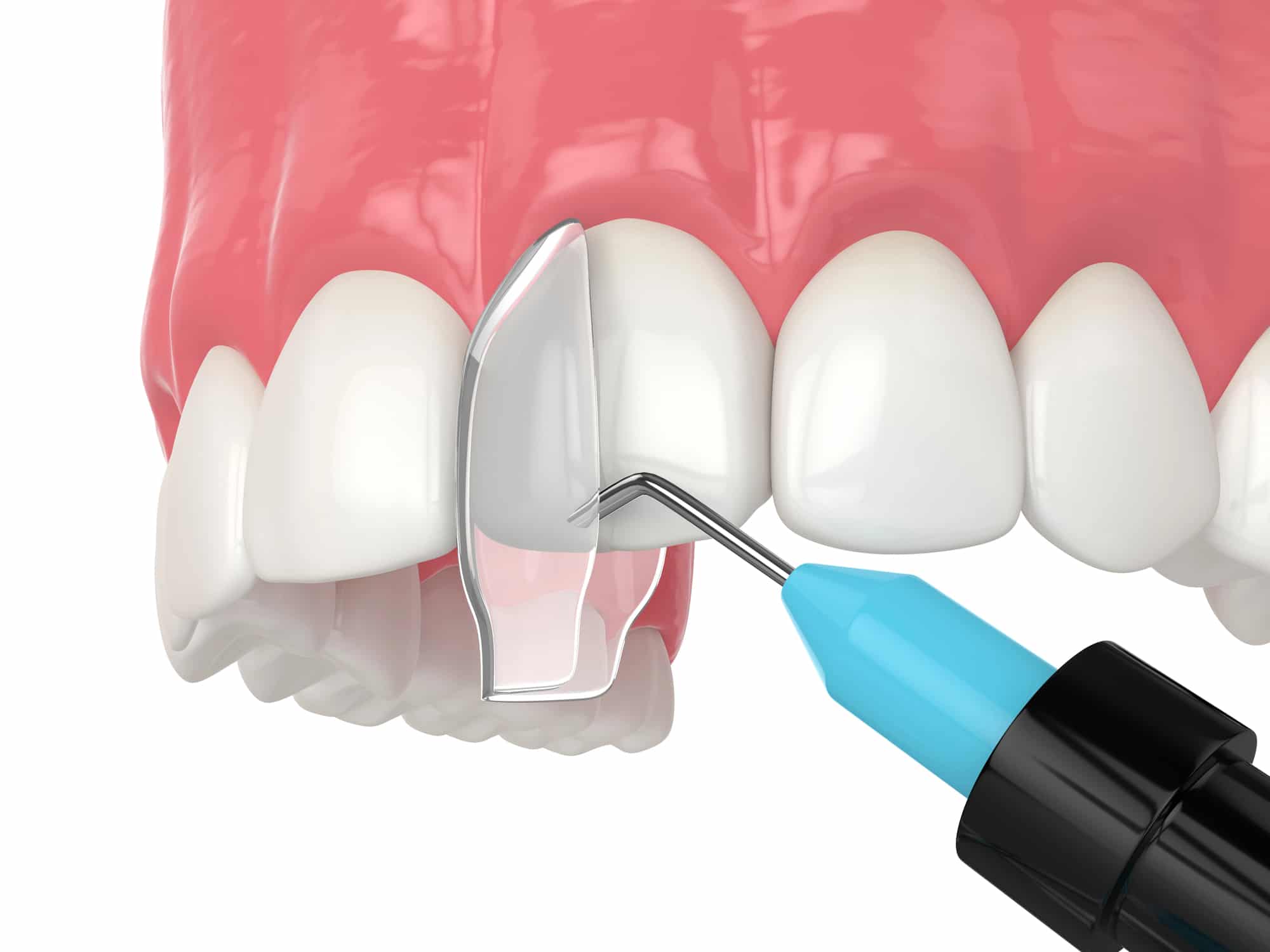 3d image of bonding from cosmetic dentist in detroit mi