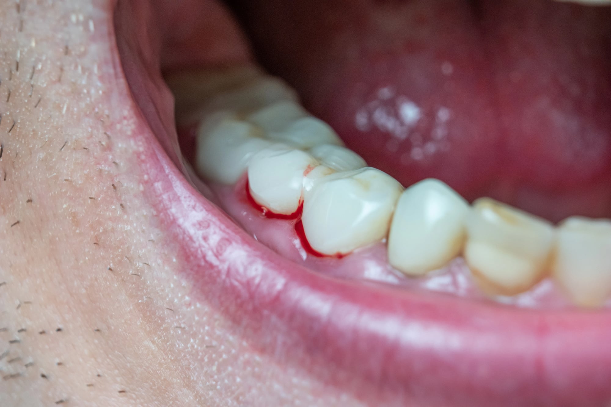 man with bleeding gums needs dentist detroit