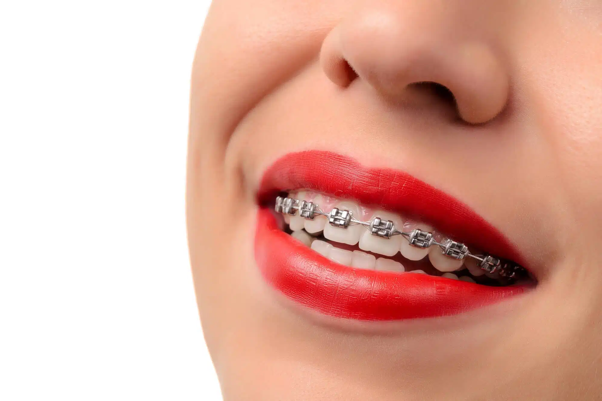Close up smile after Braces Novi, detroit