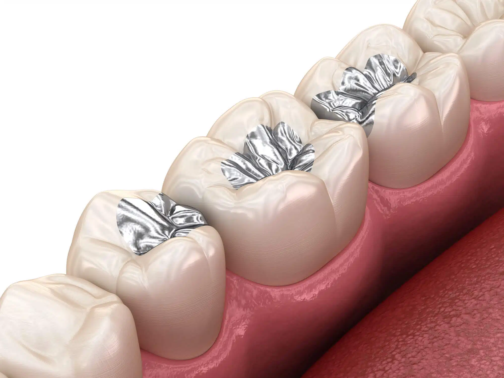 3D Illustration of dental sealants by dentist novi mi