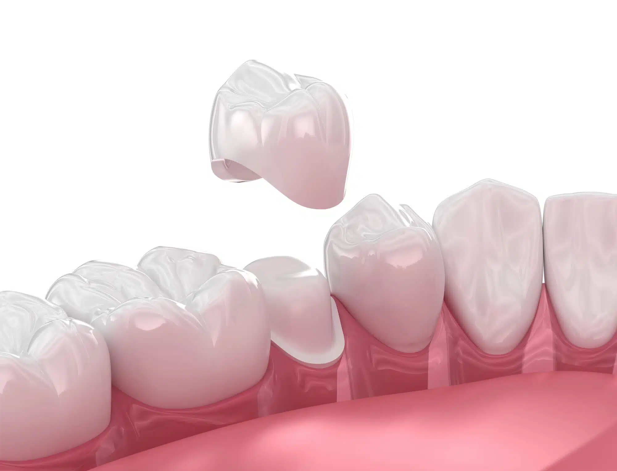 3D illustration of crowns by best dentists in novi mi