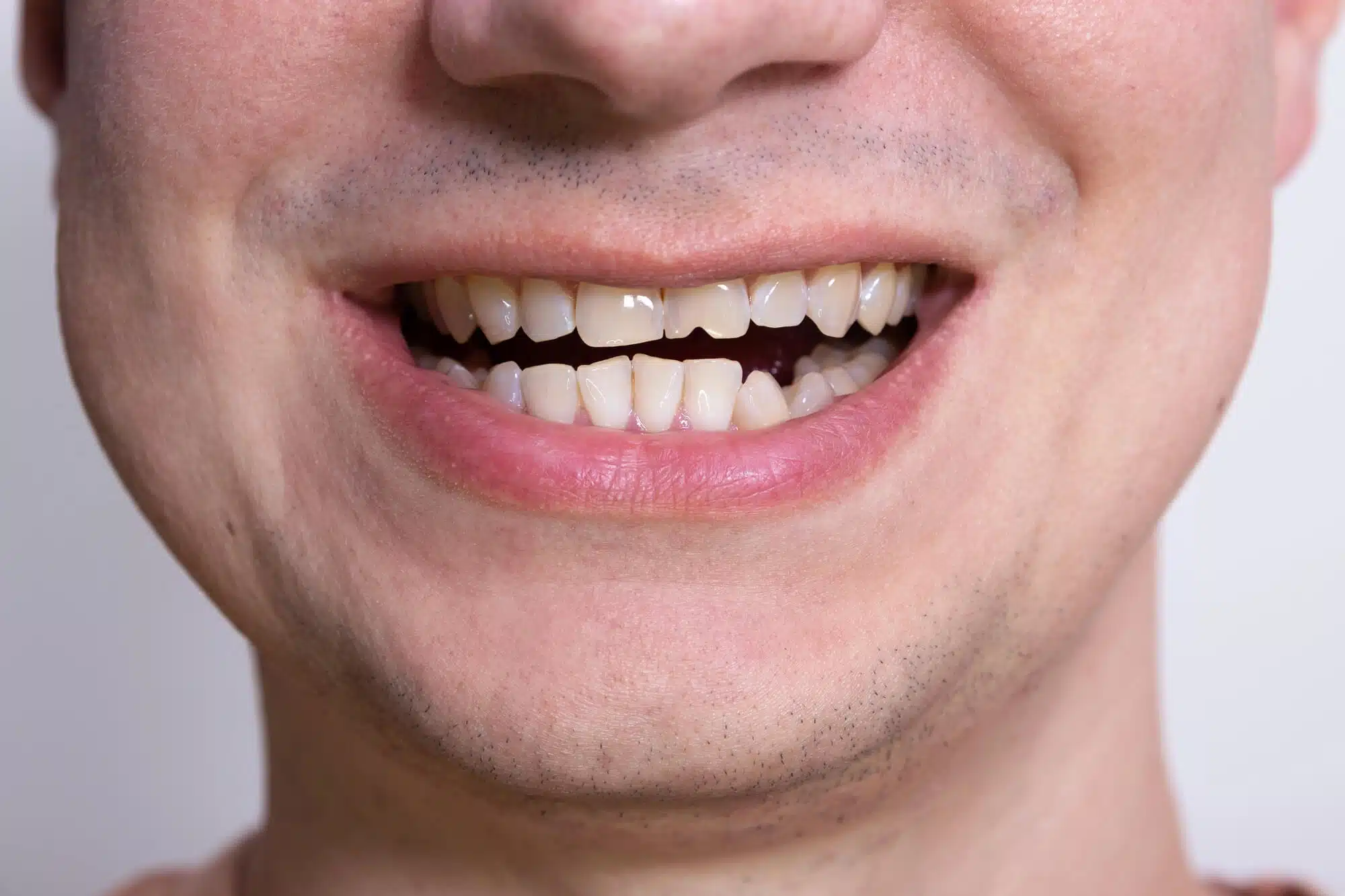 Damaged teeth needs best dentists in novi mi